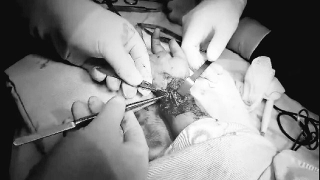 Đang tắm gặp tai nạn bất ngờ, bé trai 6 tuổi đứt gần lìa bàn tay ảnh 1