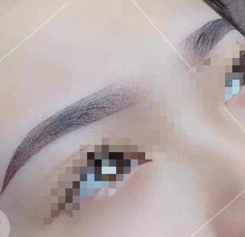 Người phụ nữ 65 tuổi nguy kịch sau khi xăm chân mày ảnh 2