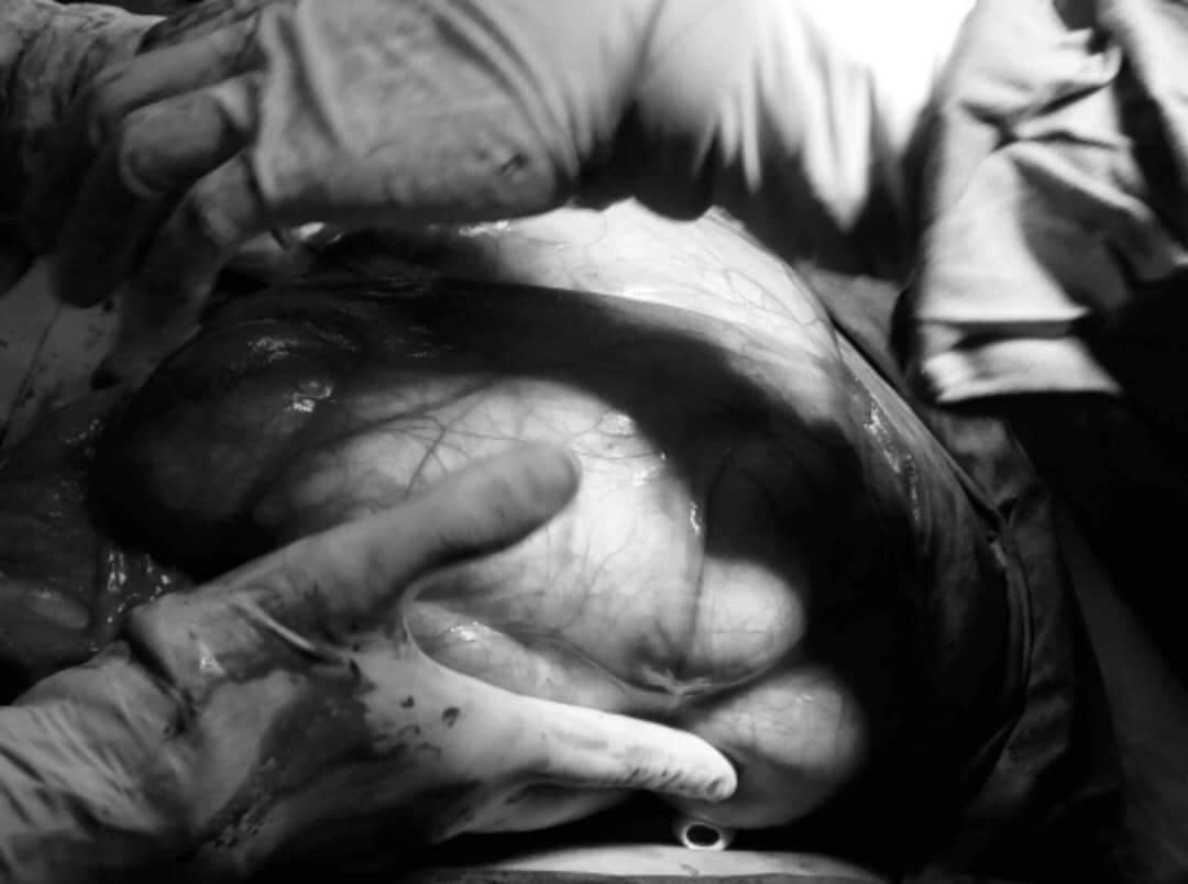 Người phụ nữ mang khối u hơn 6kg trong bụng nhưng không hay biết ảnh 1