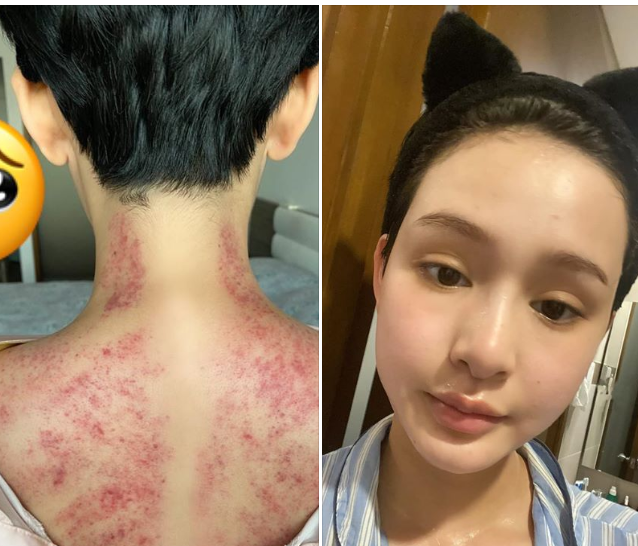 Fan hoảng hốt trước ảnh Hiền Hồ nhợt nhạt, lưng chằng chịt vết đỏ tím ảnh 1