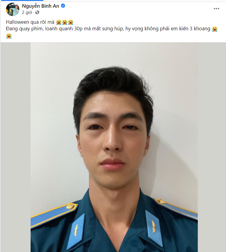 Diễn viên Bình An tung ảnh mặt sưng vù khác lạ ảnh 2