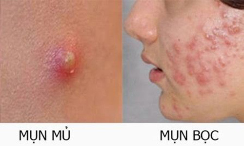 Tại sao phải dành cả thanh xuân để trị mụn khi chỉ cần bí kíp đơn giản đến không ngờ? ảnh 1