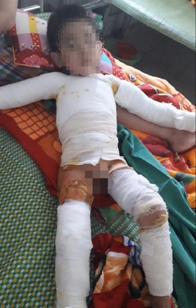 Ghép da 3 lần, bệnh nhi 5 tuổi bị bỏng nặng toàn thân được cứu sống ảnh 1