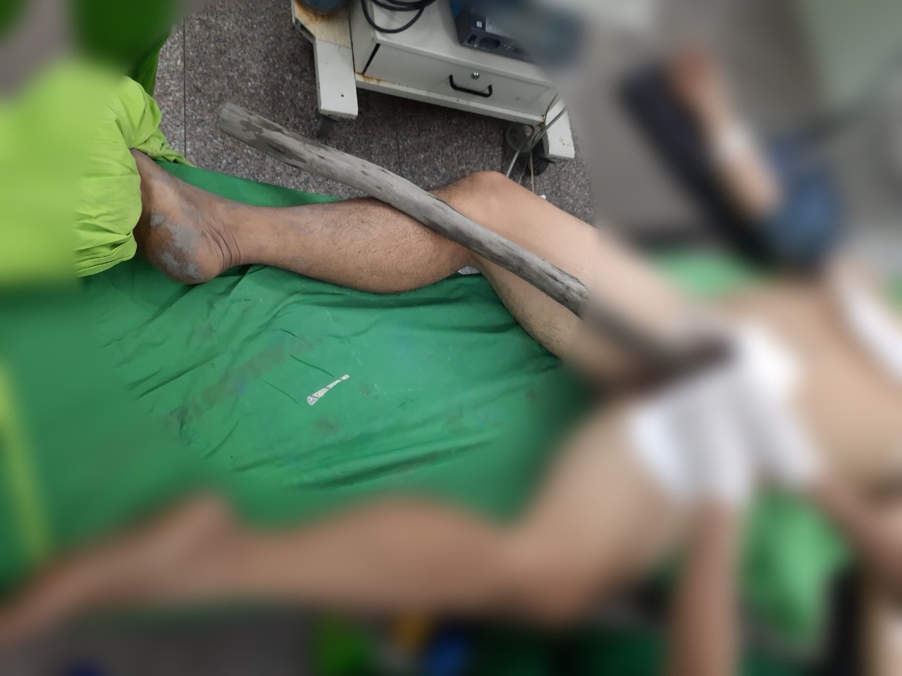 Người đàn ông mang cả cây gỗ xuyên từ tầng sinh môn đến bụng nhập viện ảnh 1