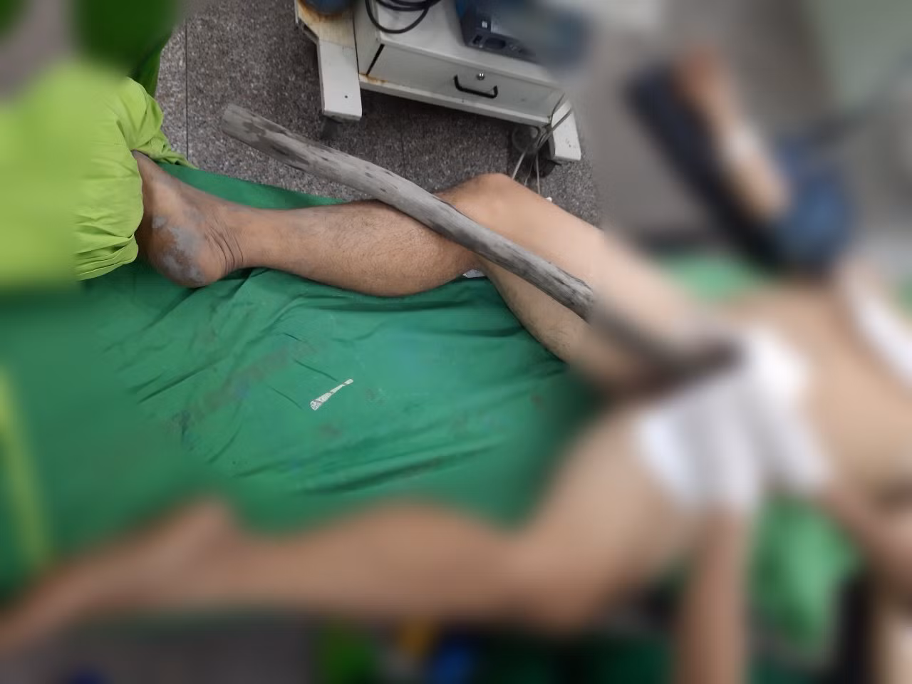 Người đàn ông mang cả cây gỗ xuyên từ tầng sinh môn đến bụng nhập viện ảnh 1