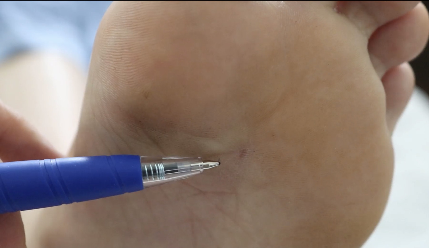 Thiếu nữ suýt mất mạng vì một vết ong đốt ảnh 1