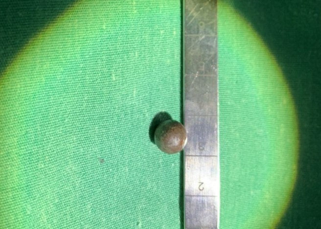 Phẫu thuật thành công cho bệnh nhân bị trúng đạn ở vị trí hiểm hóc ảnh 2