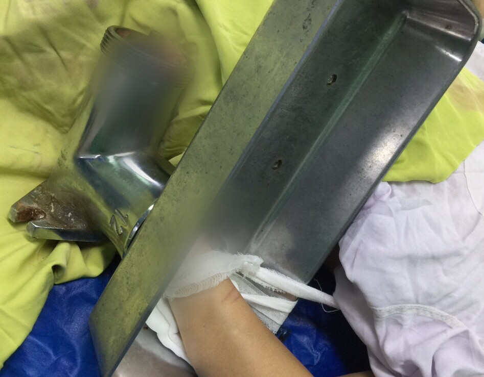 Rút nhầm phích cắm điện, người phụ nữ bị máy xay thịt cuốn nát bàn tay ảnh 1