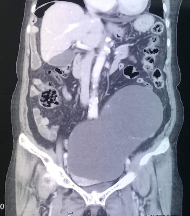 Lấy thành công khối u gần 3kg ra khỏi cơ thể cụ bà U100 ảnh 1