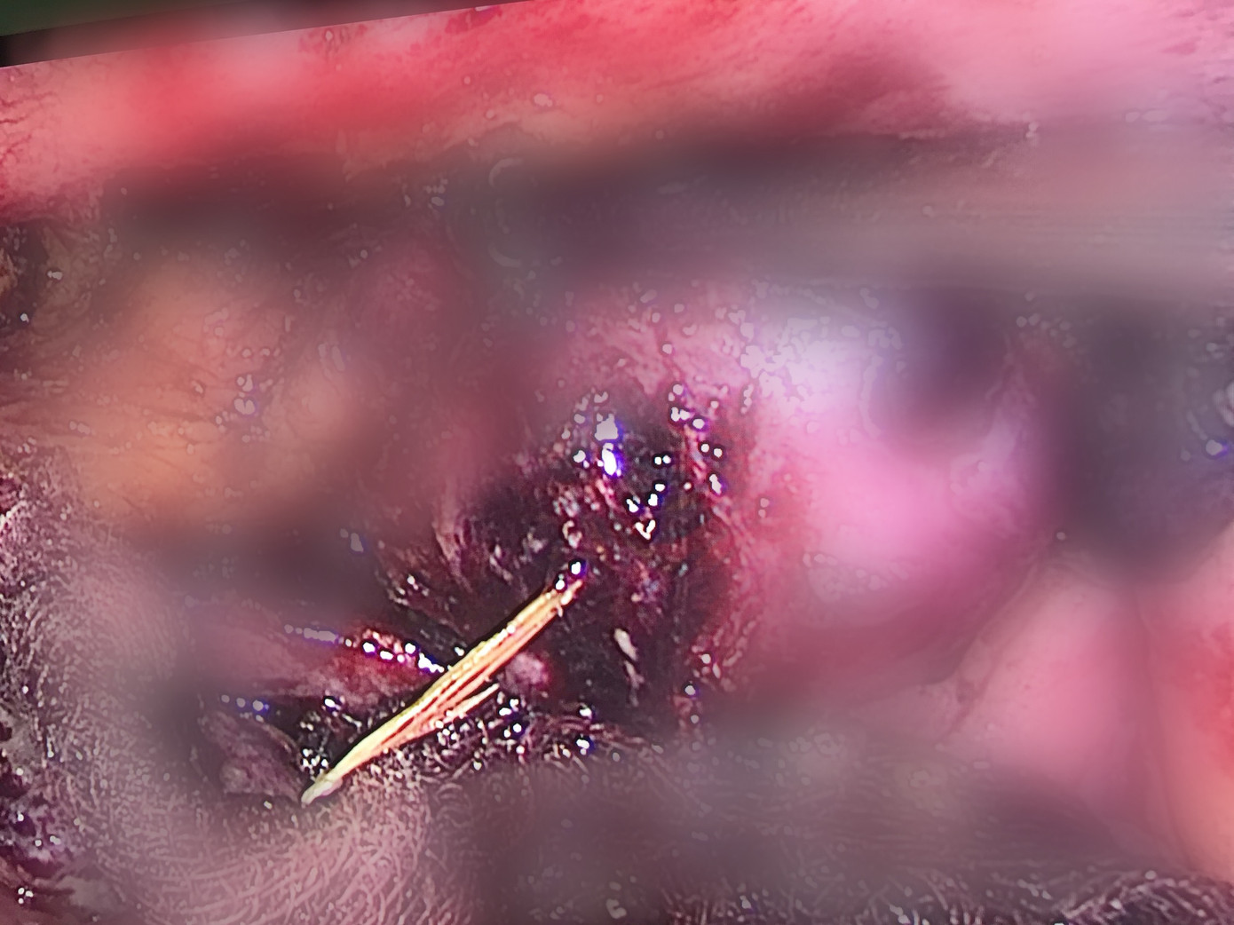 Nuốt cơm cháy để chữa hóc xương, người phụ nữ bị xương đâm thủng ruột ảnh 1