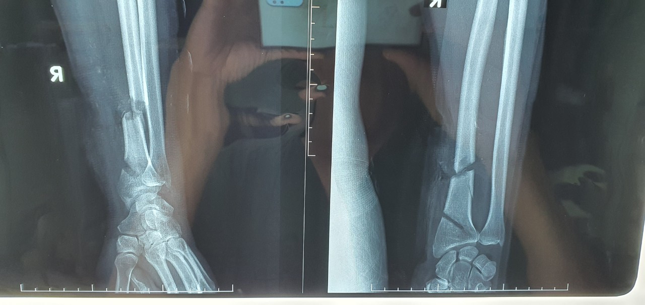 Dùng máy cưa tỉa cây, người đàn ông bị cắt đứt gần lìa cổ tay và cổ chân ảnh 1