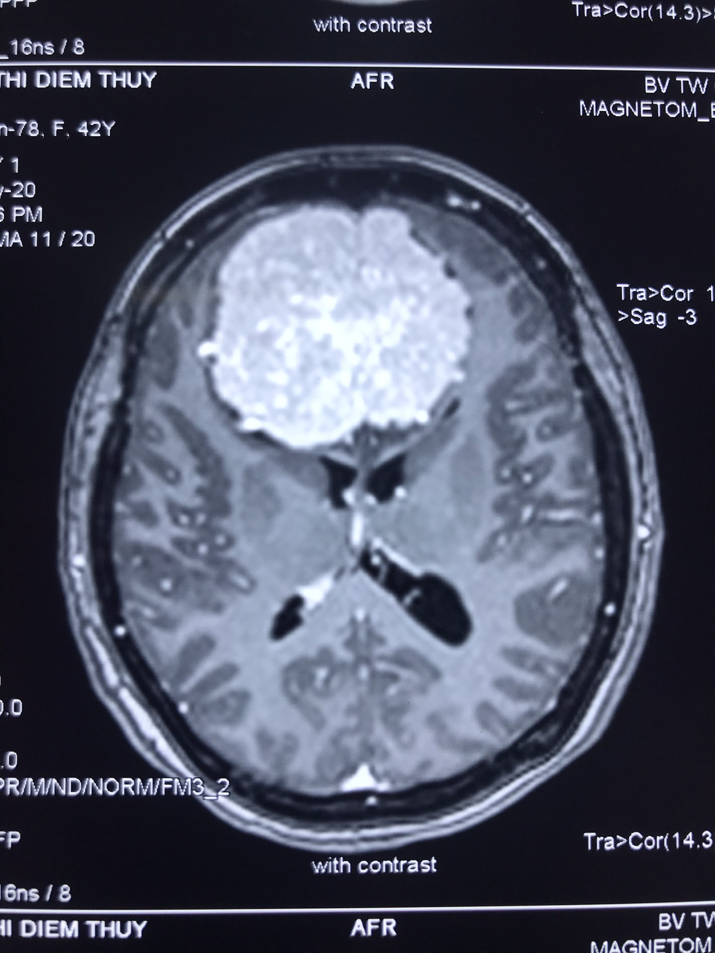 Khám đau đầu, người phụ nữ tá hỏa phát hiện có u não khổng lồ ảnh 1