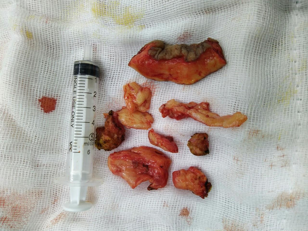 Bơm silicon để tăng kích thước ‘cậu nhỏ’, người đàn ông suýt mất ‘của quý’ ảnh 2