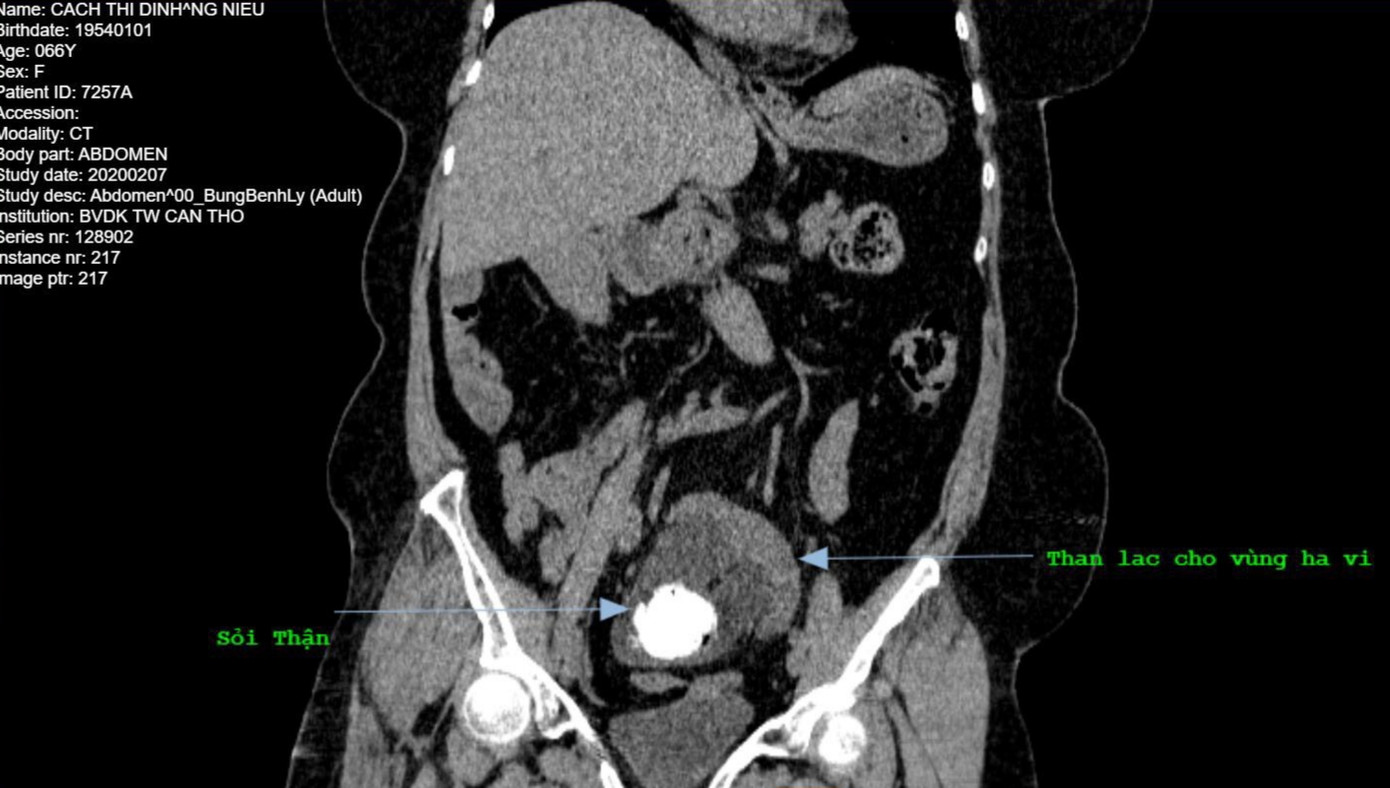 Phẫu thuật thành công cho người phụ nữ có thận nằm ở vị trí lạ ảnh 1