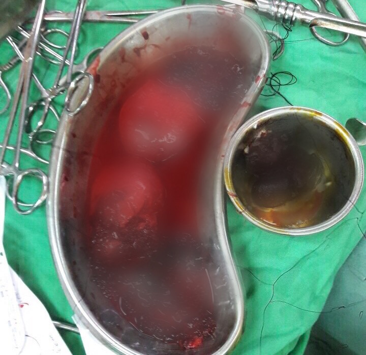 Đi bộ băng qua đường, người phụ nữ bị xe tông khiến thận vỡ đôi ảnh 1