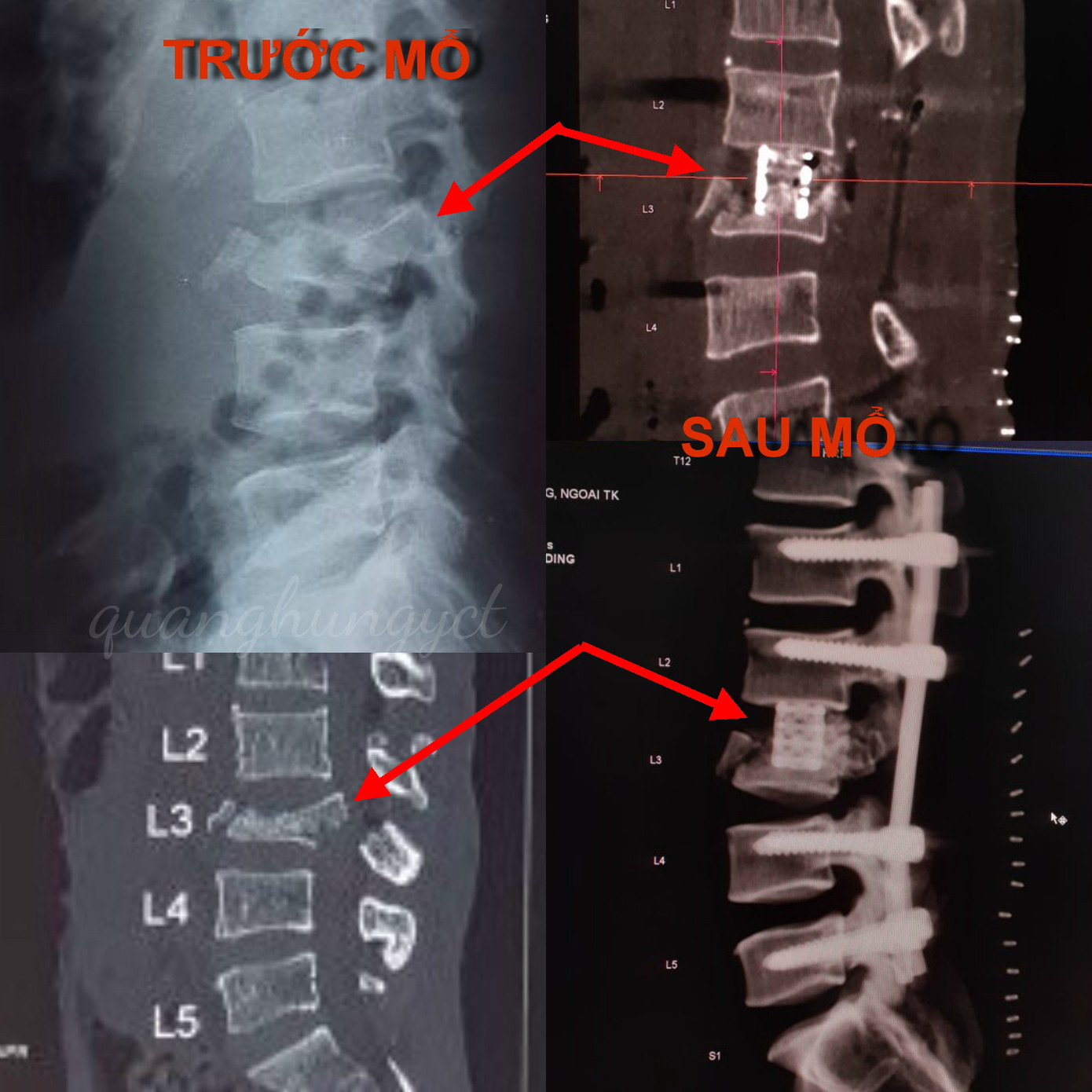 Trèo cây hái dừa, nam thanh niên ngã nát đốt sống ảnh 1