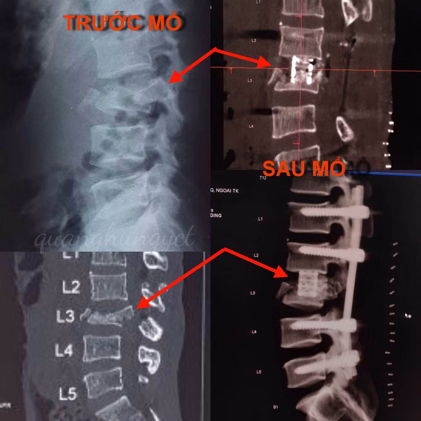Trèo cây hái dừa, nam thanh niên ngã nát đốt sống ảnh 1