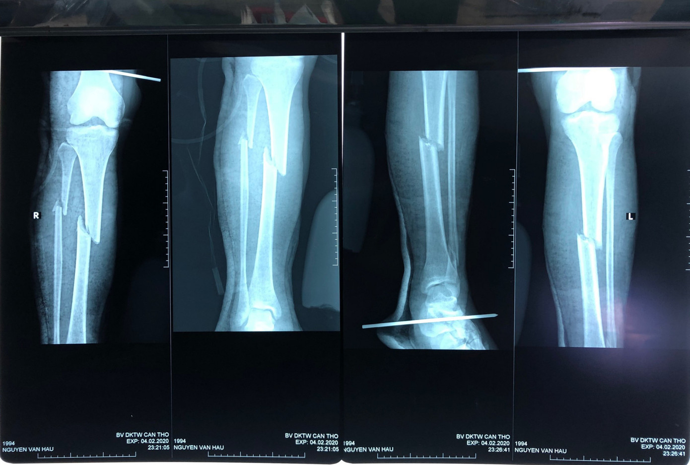 Phẫu thuật thành công ca gãy xương hiếm gặp ở 6 vị trí ảnh 2