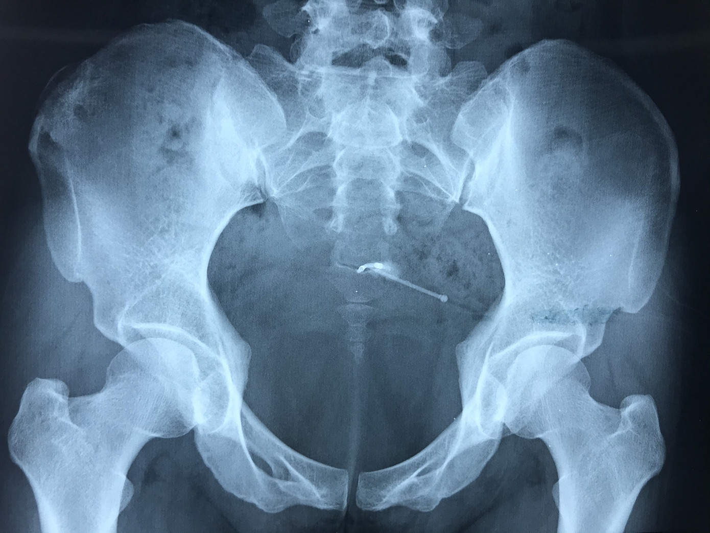 Mổ sỏi bàng quang tá hỏa phát hiện vòng tránh thai đặt 10 năm bị 'lạc trôi' ảnh 1