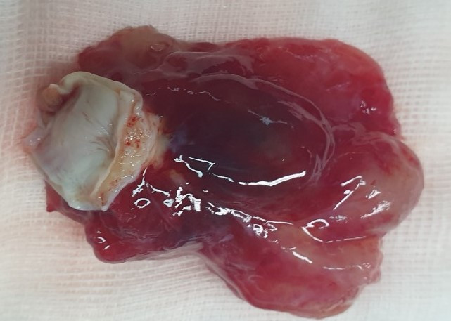 Khối u tim to bằng quả trứng, nữ bệnh nhân may mắn thoát cửa tử thần ảnh 1