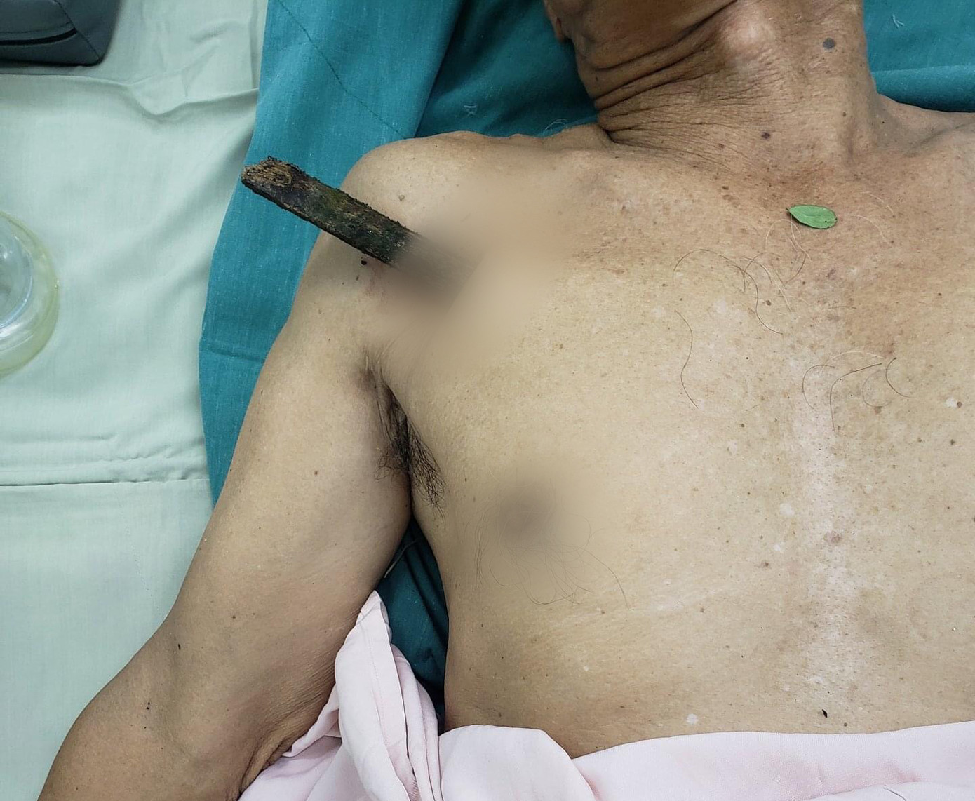 Ngã xe đạp, cụ ông 70 tuổi bị thanh gỗ dài 30cm đâm thủng phổi ảnh 1