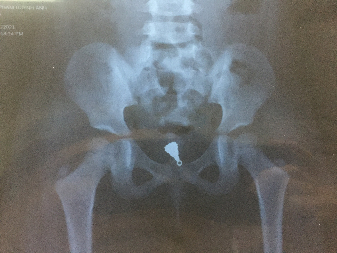 Lấy thành công mặt dây chuyền nằm trong 'vùng kín' bé gái 5 tuổi ảnh 1