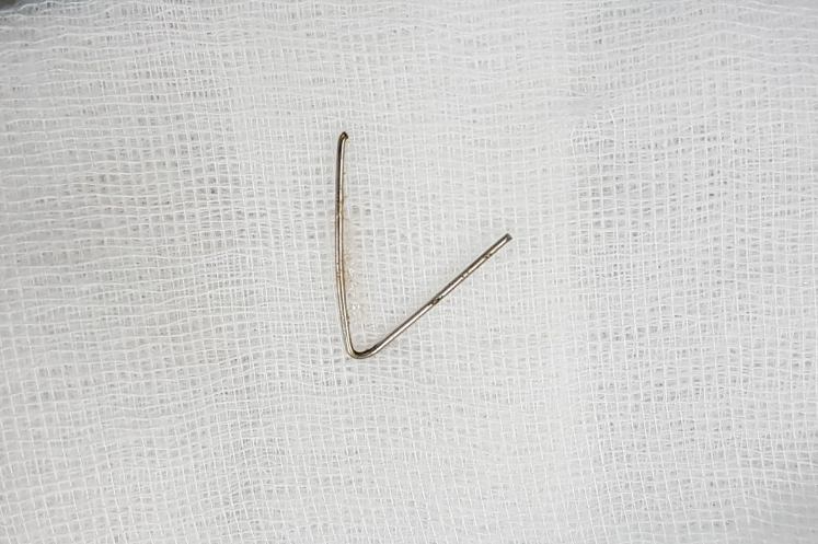 Lấy thành công đoạn kim loại 7cm trong cổ họng bé gái 5 tuổi ảnh 2