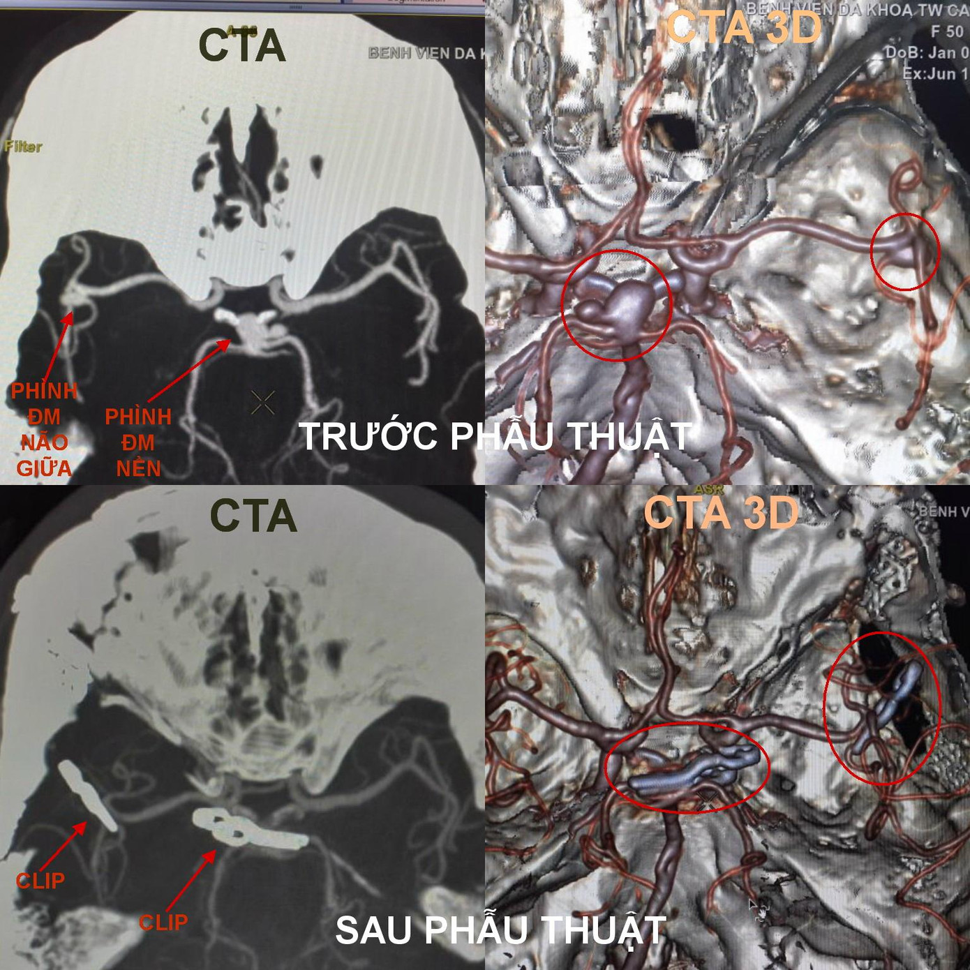 Suýt chết vì vỡ túi phình mạch máu não ở vị trí hiểm hóc ảnh 1