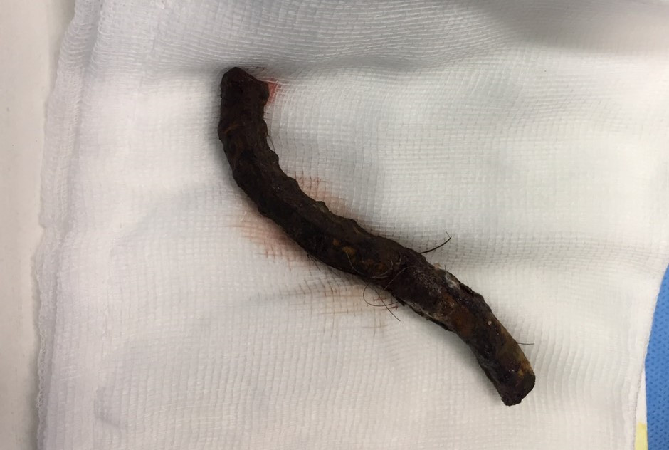 Bị thanh sắt phi 12 đâm xuyên sọ, người đàn ông may mắn thoát chết ảnh 1