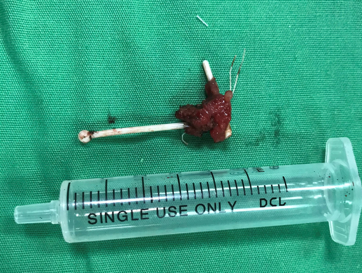 Mổ sỏi bàng quang tá hỏa phát hiện vòng tránh thai đặt 10 năm bị 'lạc trôi' ảnh 2