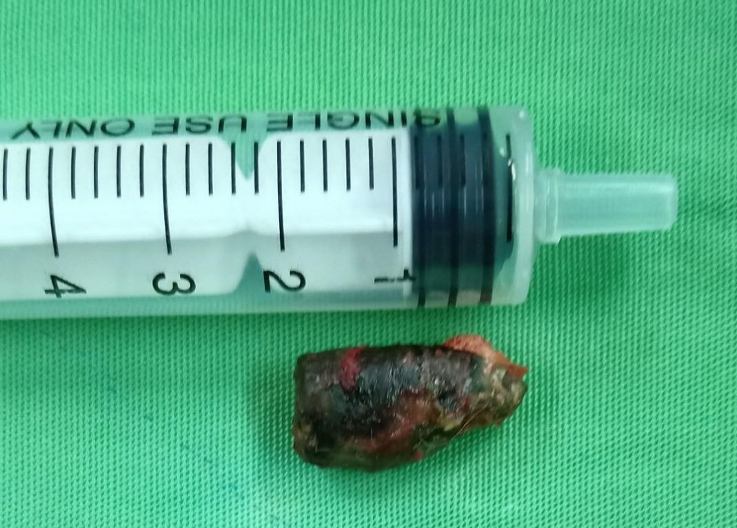 Lấy đầu viên đạn nằm trong cơ thể người đàn ông suốt nửa thế kỉ ảnh 1