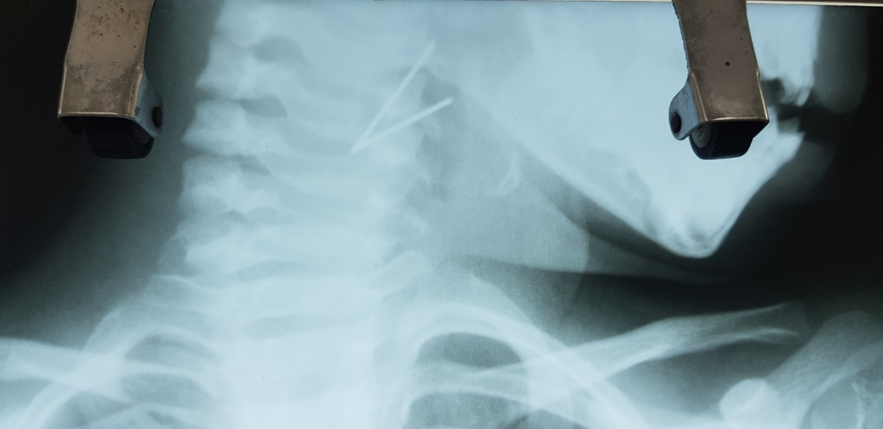 Lấy thành công đoạn kim loại 7cm trong cổ họng bé gái 5 tuổi ảnh 1