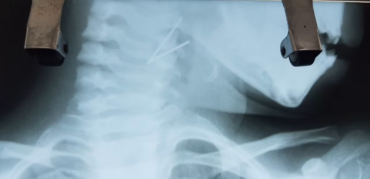 Lấy thành công đoạn kim loại 7cm trong cổ họng bé gái 5 tuổi ảnh 1