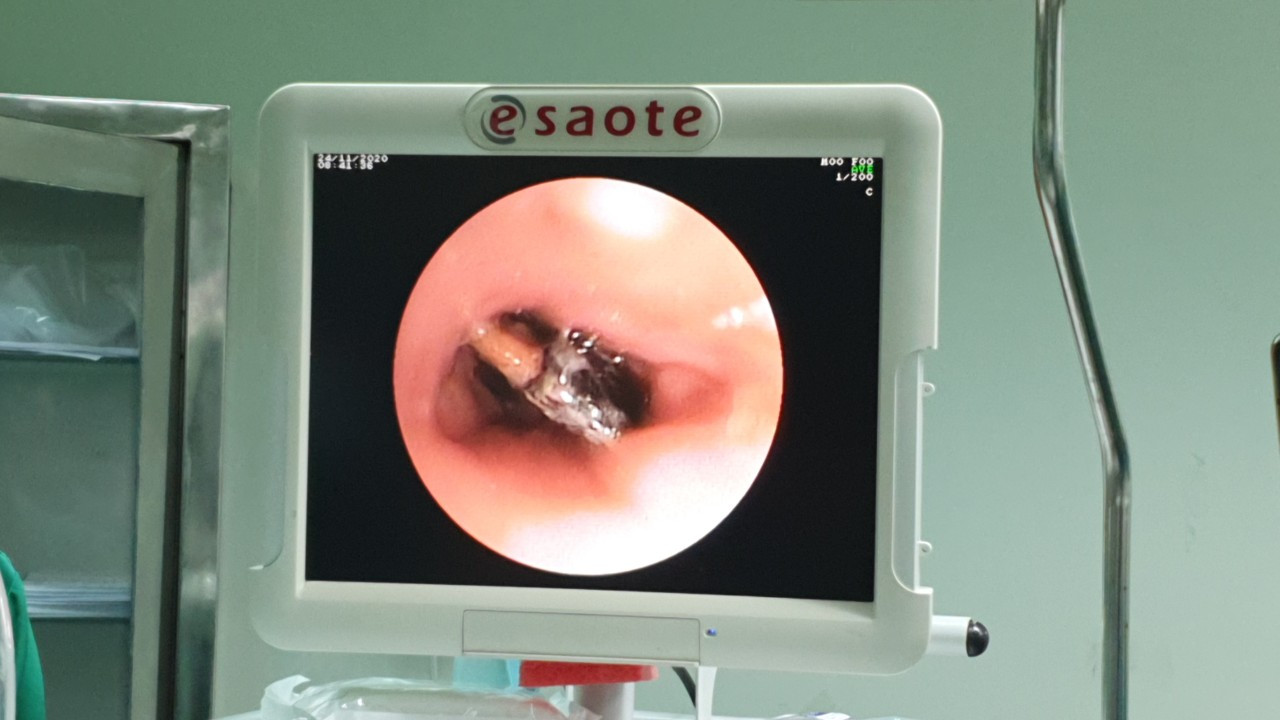 Gỡ hạt hồng xiêm nằm vắt ngang trong phế quản cô gái suốt 27 năm ảnh 1