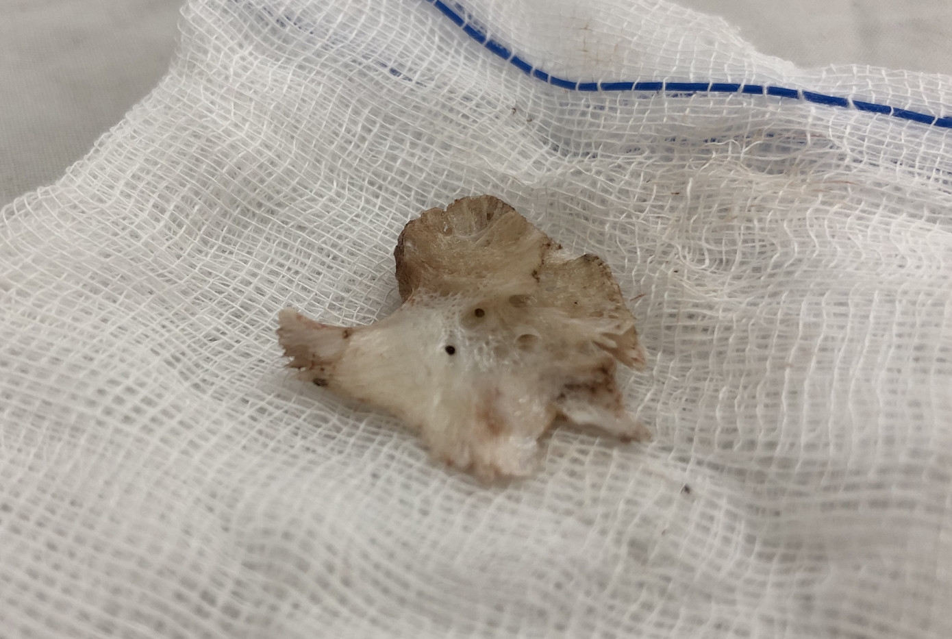 Gắp xương cá 'khủng' cắm trong thực quản người đàn ông bị tai biến ảnh 1