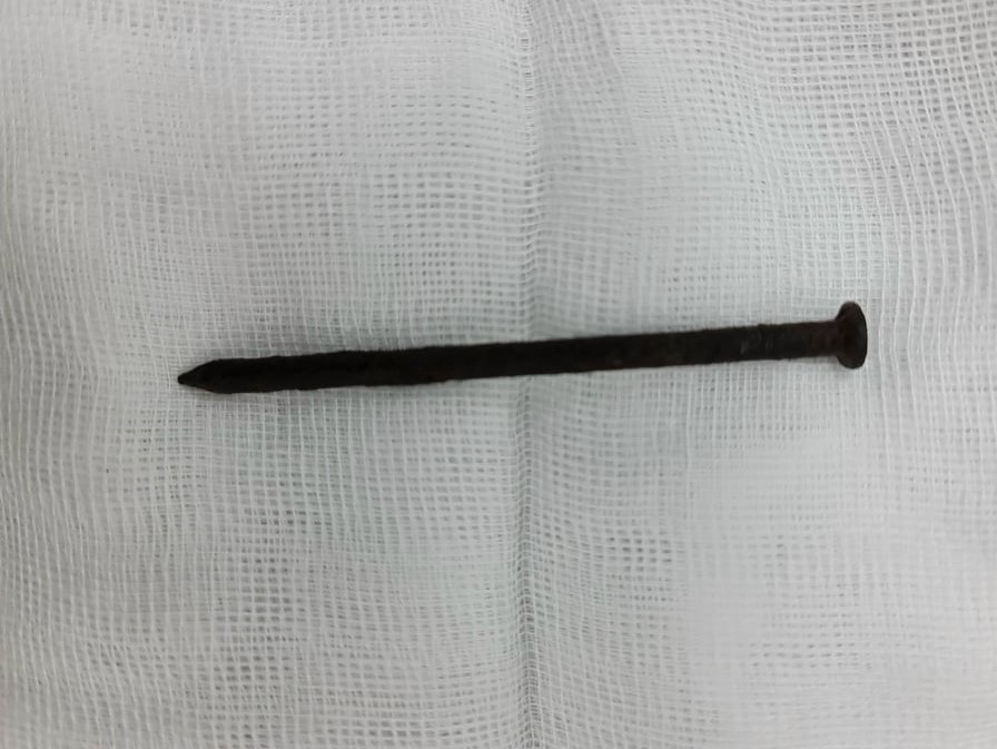 Suýt chết vì tự nuốt đinh sắt dài 8cm vào bụng ảnh 1