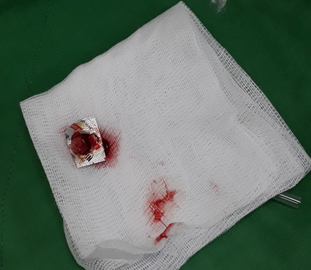 Hi hữu, người đàn ông bị kẹt vỏ thuốc trong khí quản suốt một năm ảnh 2