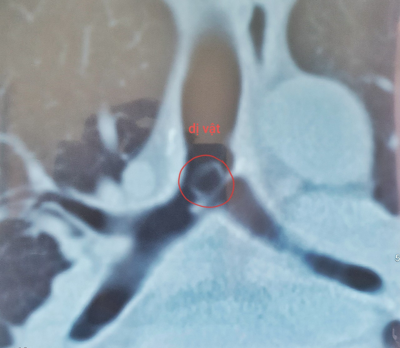 Hi hữu, người đàn ông bị kẹt vỏ thuốc trong khí quản suốt một năm ảnh 1