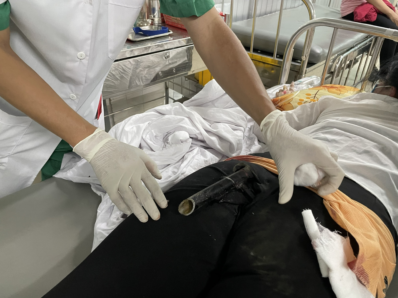 Bệnh nhân bị chân chống xe máy cắm vào mông sau tai nạn giao thông. Va chạm giao thông, cô gái bị chân chống xe máy đâm dính vào vùng mông ảnh 1