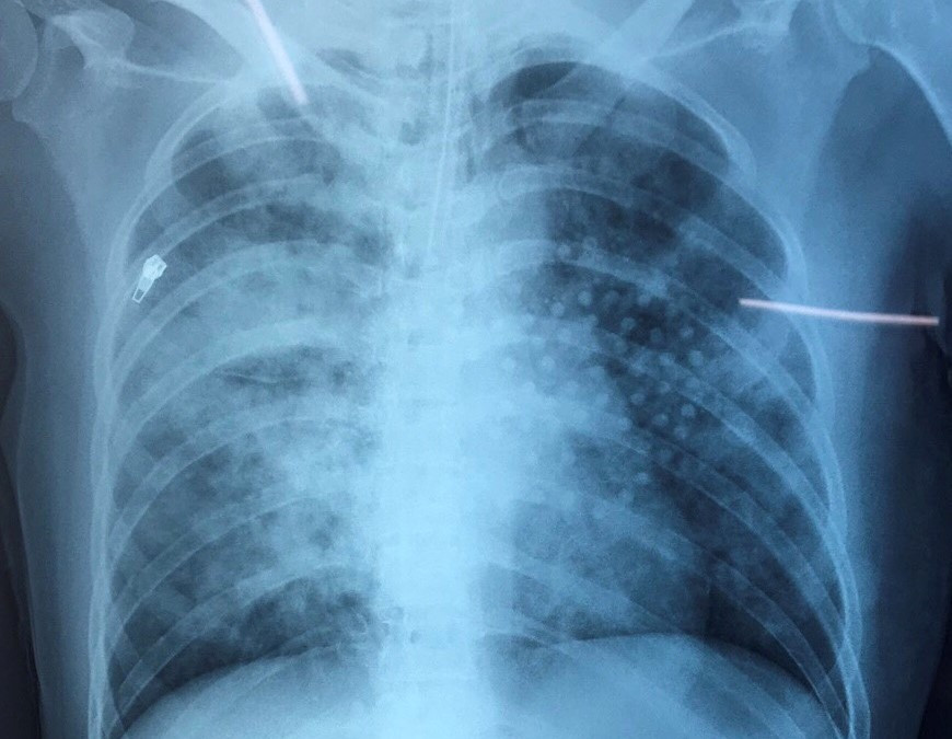 Phổi ngập đầy bùn vì đuối nước, cô gái may mắn thoát chết ảnh 1