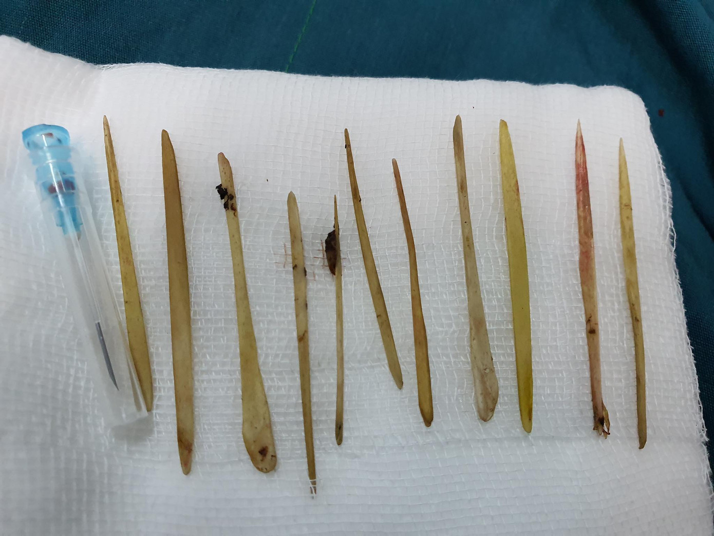 Người đàn ông bị thủng ruột vì ăn nhầm 11 chiếc tăm lúc nhậu say ảnh 1