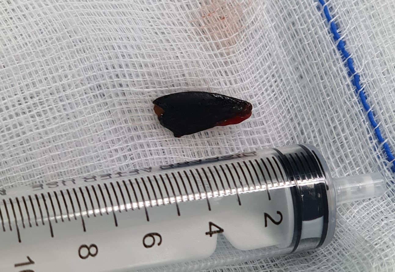 Gỡ hạt hồng xiêm nằm vắt ngang trong phế quản cô gái suốt 27 năm ảnh 2