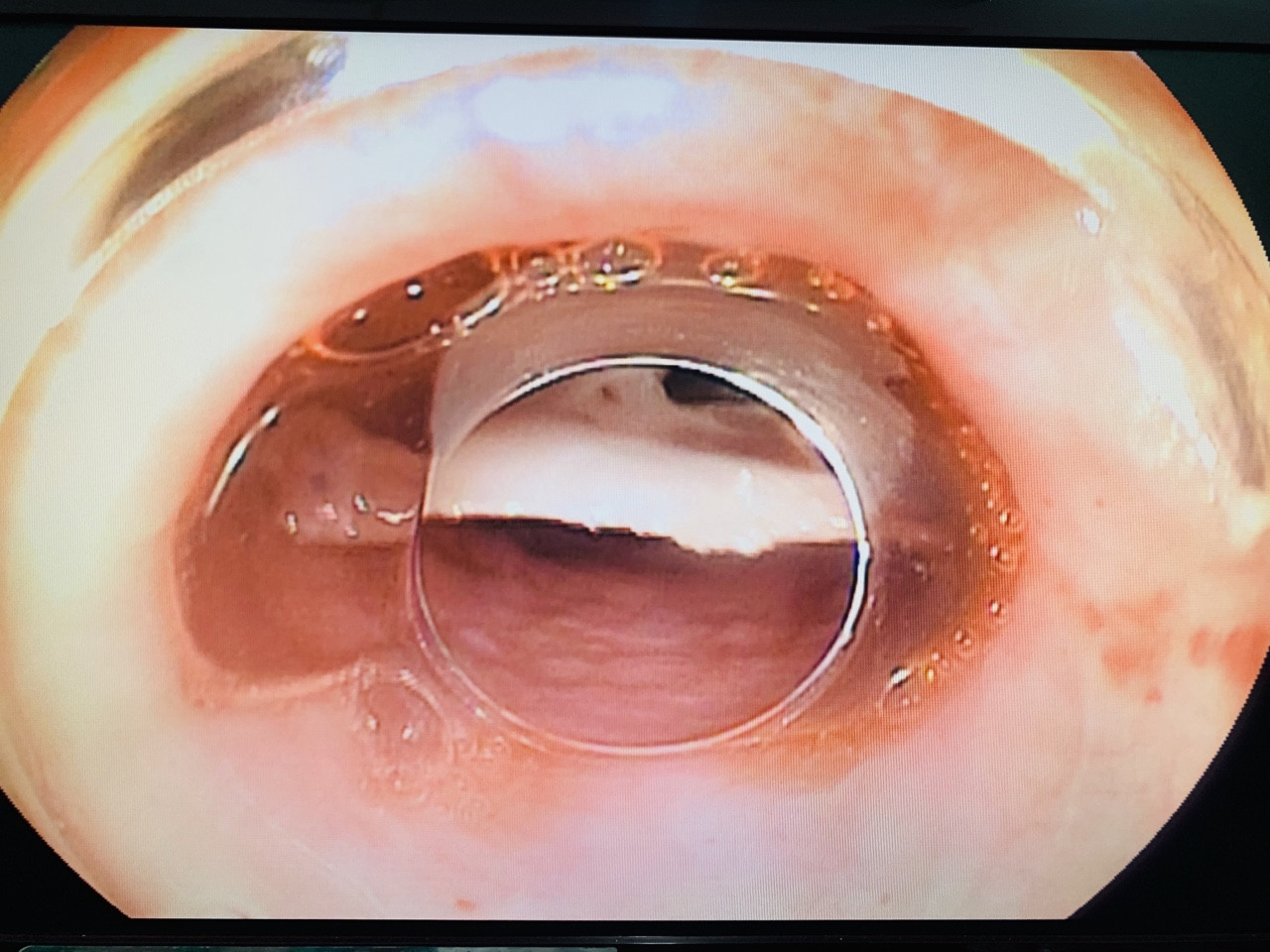 Gắp xương cá 'khủng' cắm trong thực quản người đàn ông bị tai biến ảnh 2