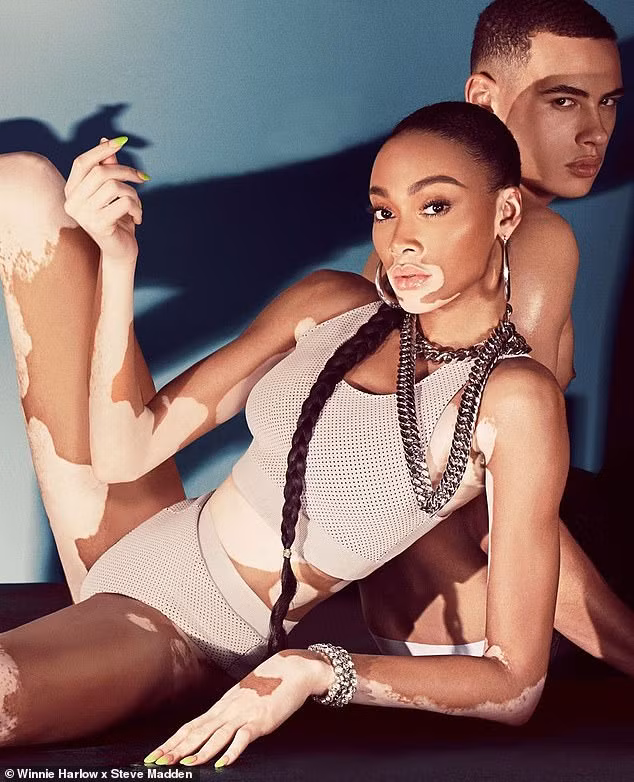 Siêu mẫu bạch biến gây ngỡ ngàng với vóc dáng hoàn hảo khó rời mắt ảnh 6