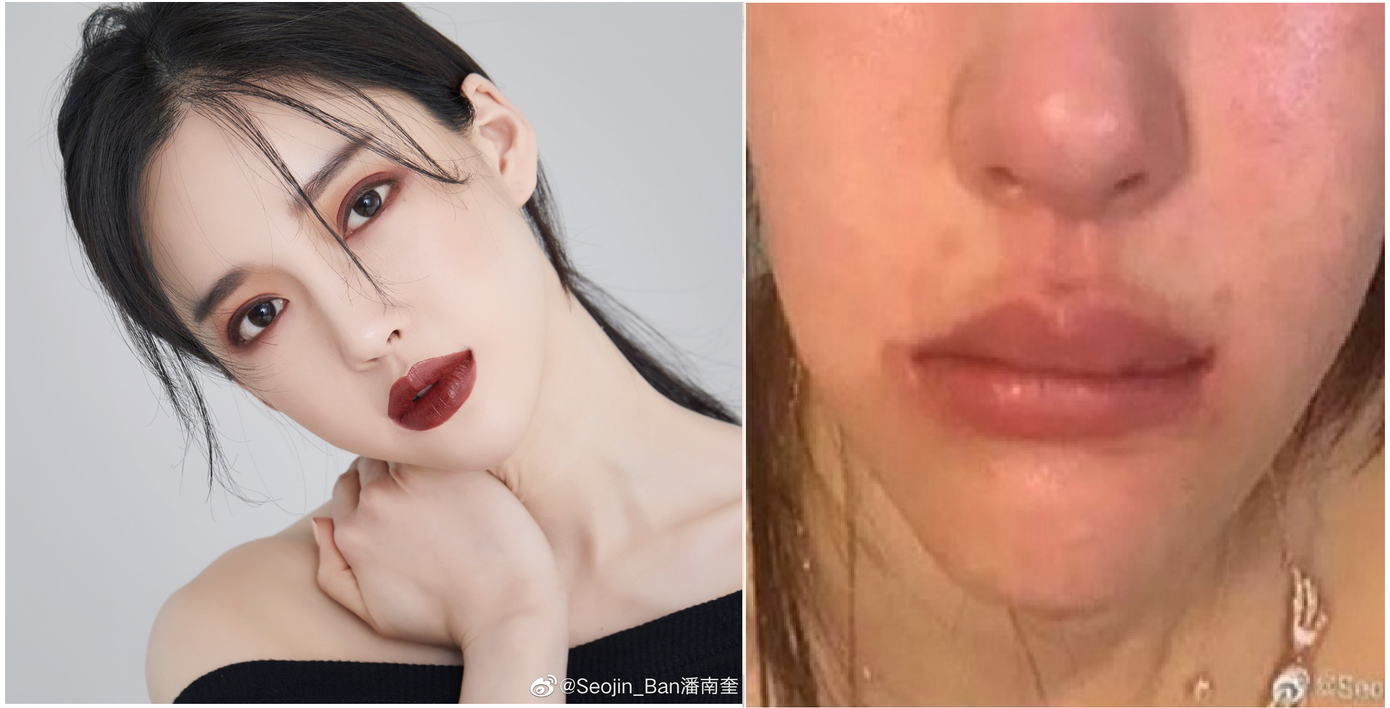 'Bản sao 19 tỷ' của AngelaBaby tố bị CEO bạo hành sưng bầm mặt ảnh 2