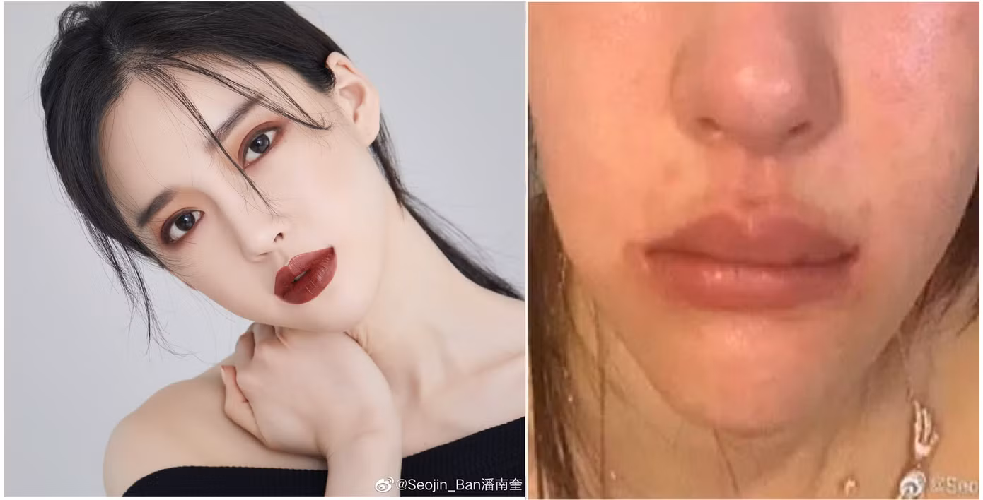 'Bản sao 19 tỷ' của AngelaBaby tố bị CEO bạo hành sưng bầm mặt ảnh 2
