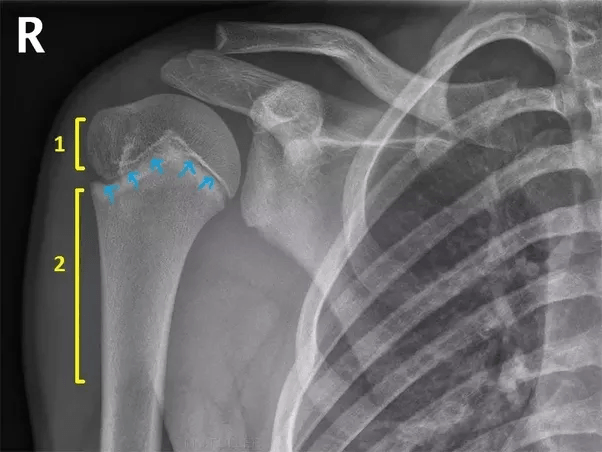 1001 thắc mắc: Kỳ lạ vì sao em bé lắm xương hơn người lớn? ảnh 1