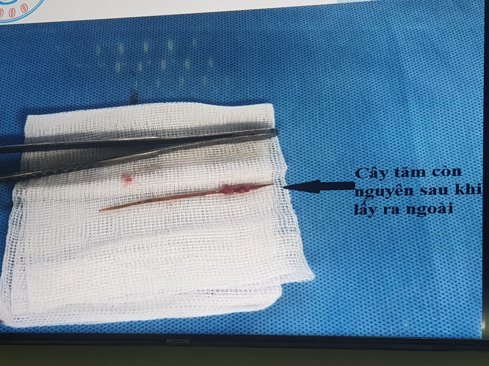 Người đàn ông suýt chết vì tăm xỉa răng dài 10cm lọt vào tim ảnh 1