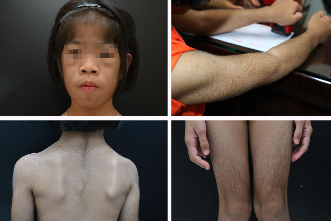 Bệnh nhân đầu tiên ở Việt Nam được phát hiện mắc di truyền hiếm gặp, thế giới chỉ vài ca ảnh 3