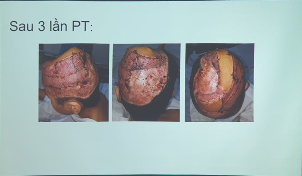 Cuốn tóc vào máy xay đá, bé 11 tuổi bị tróc da đầu lộ cả hộp sọ ảnh 1